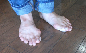 外反母趾　扁平足　指の胼胝　沖縄・那覇の健康靴・インソール専門店　マキの靴　