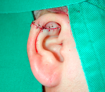 耳ケロイドの発生率