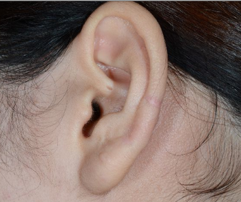 耳ケロイド切除後の電子線照射