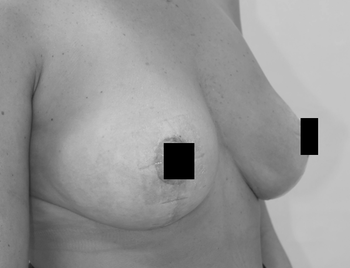 乳房リフトは、重力に逆らう手術