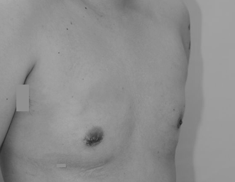 性同一性障害に対するFTM乳腺切除術