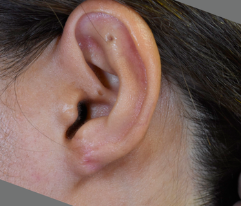 耳ケロイド、再々発症例、術後1年の経過
