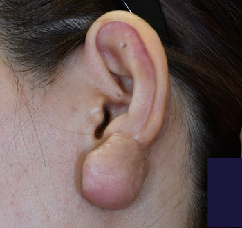 耳ケロイド、再々発症例、術後1年の経過