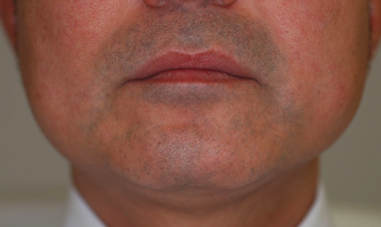 男性、口周囲のヒゲ、レーザー脱毛10年後の経過