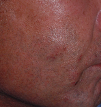 右頬の粉瘤、くりぬき法で切除後8年の経過