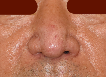 “鼻瘤”に対する皮膚剥削術後4ヶ月の経過