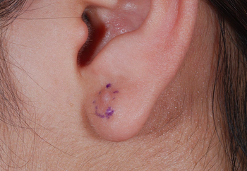 耳ケロイド、12年間に3回の手術を施行