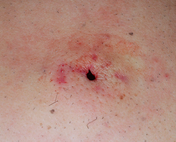 背部の粉瘤、くりぬき法で治療後６年の経過