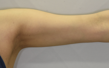 上腕のベイザー脂肪吸引、術後６ヶ月の経過