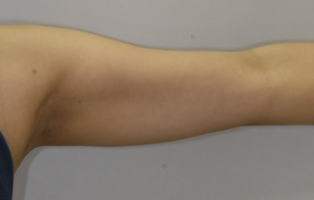 上腕のベイザー脂肪吸引、術後６ヶ月の経過