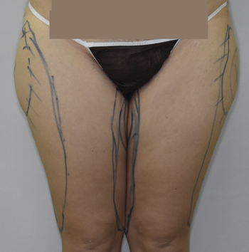 大腿部のベイザー脂肪吸引、術後1ヶ月の経過