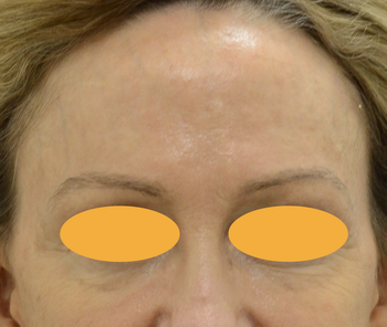 顔面への定期的ボトックス注射、7年の経過