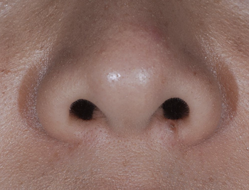 外鼻孔のホクロ、炭酸ガスレーザー治療後12年の経過