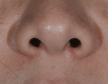 外鼻孔のホクロ、炭酸ガスレーザー治療後12年の経過