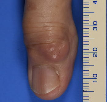 指の不整形のしこりを診たら、まず“腱鞘巨細胞腫”