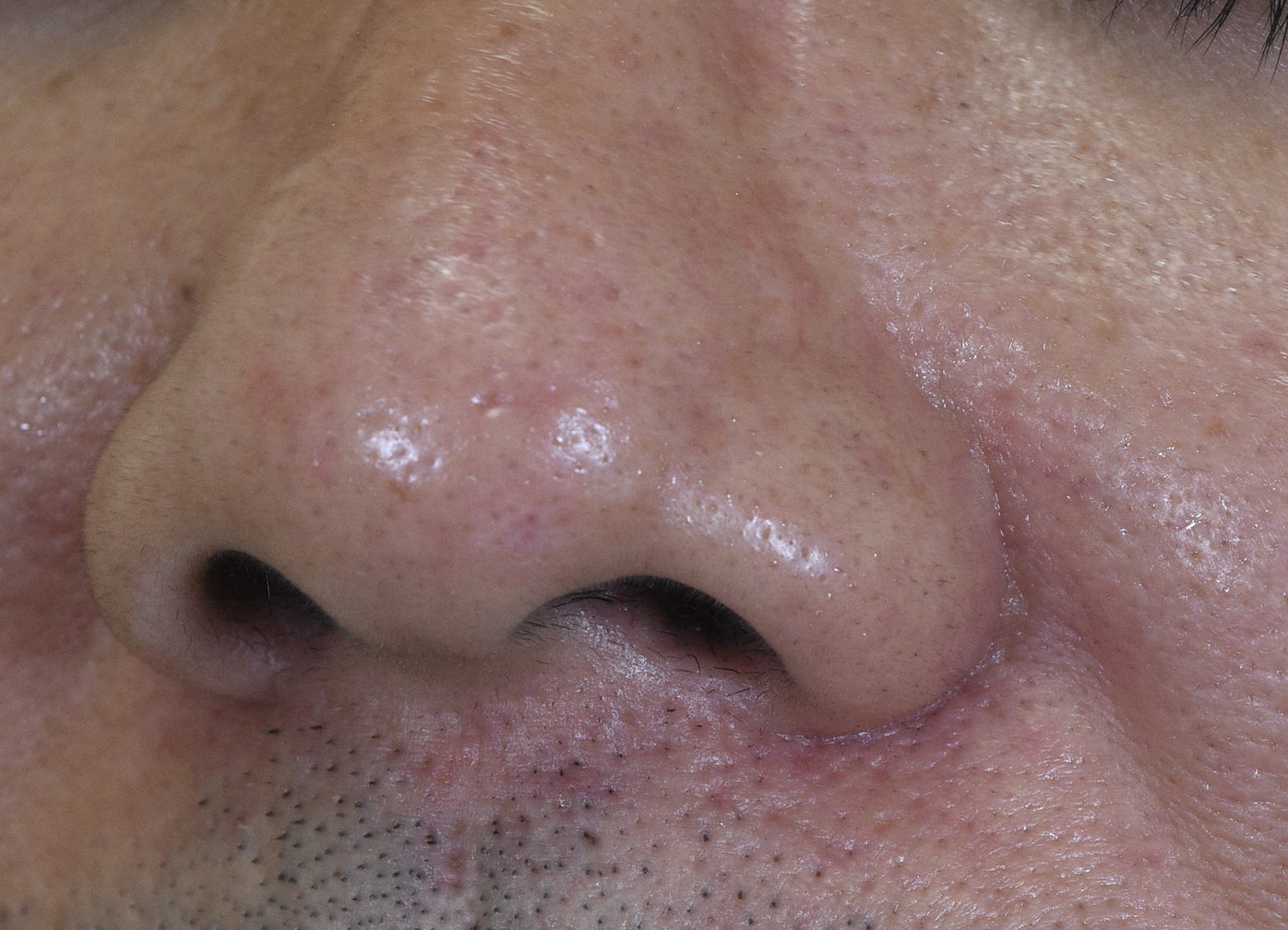 鼻のホクロ、炭酸ガスレーザー治療後7年の経過