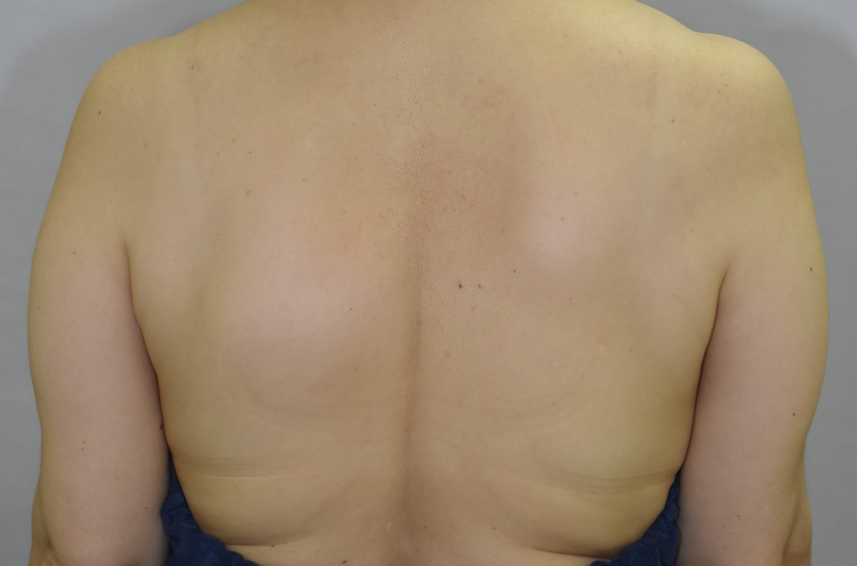 背部の大きな脂肪腫、切除後２年の経過