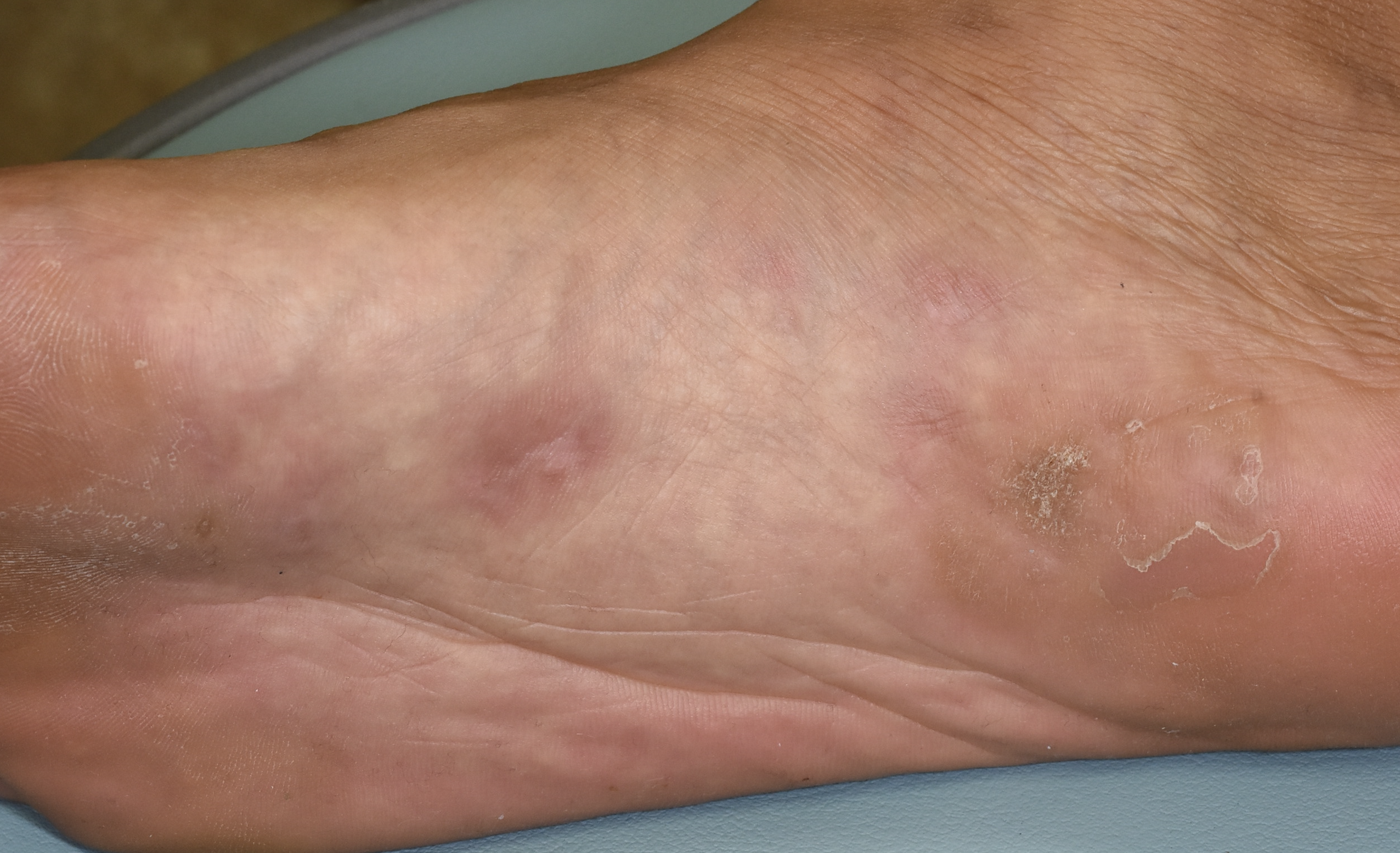 足底のイボ　“尋常性疣贅”、レメディで治療後2ヶ月の経過
