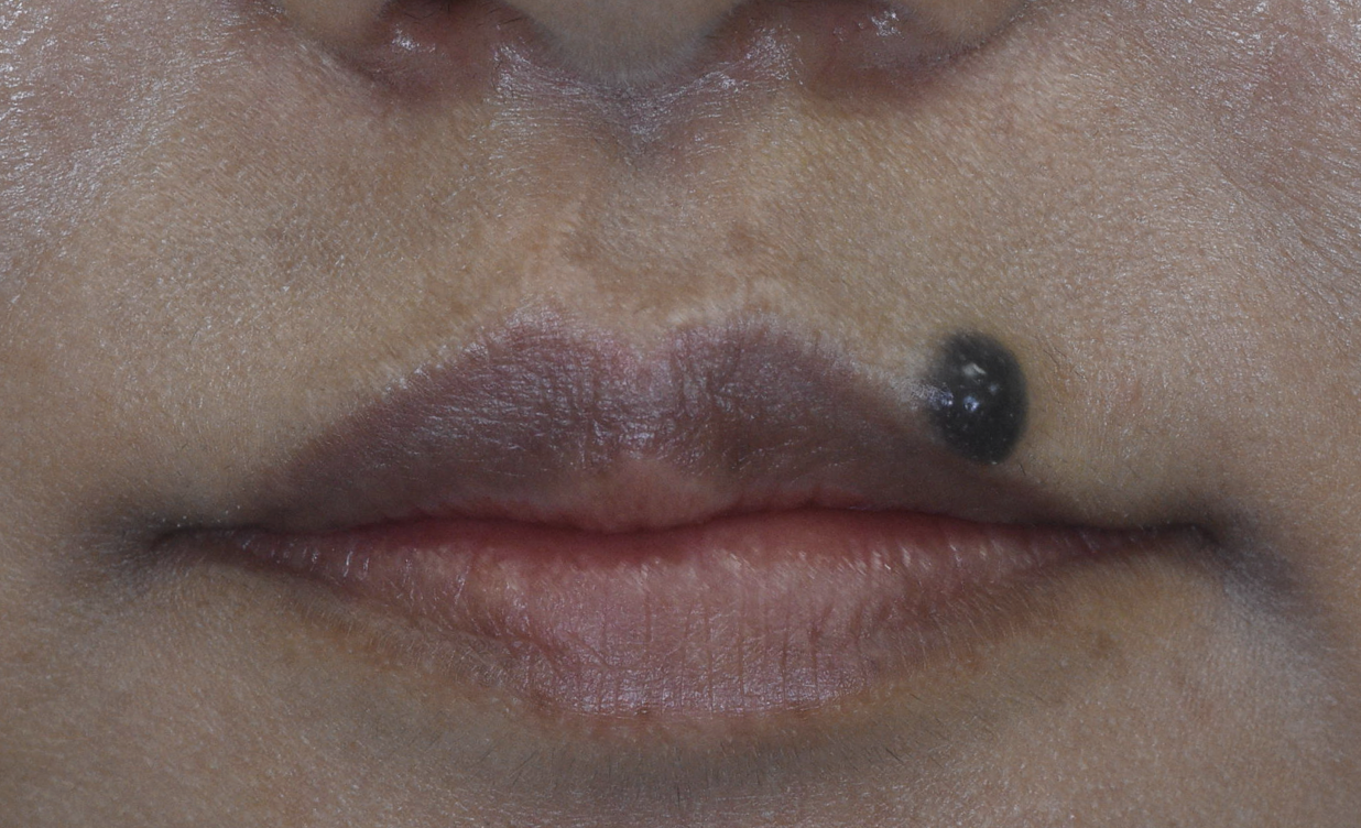 上口唇のホクロ、切除後4ヶ月の経過