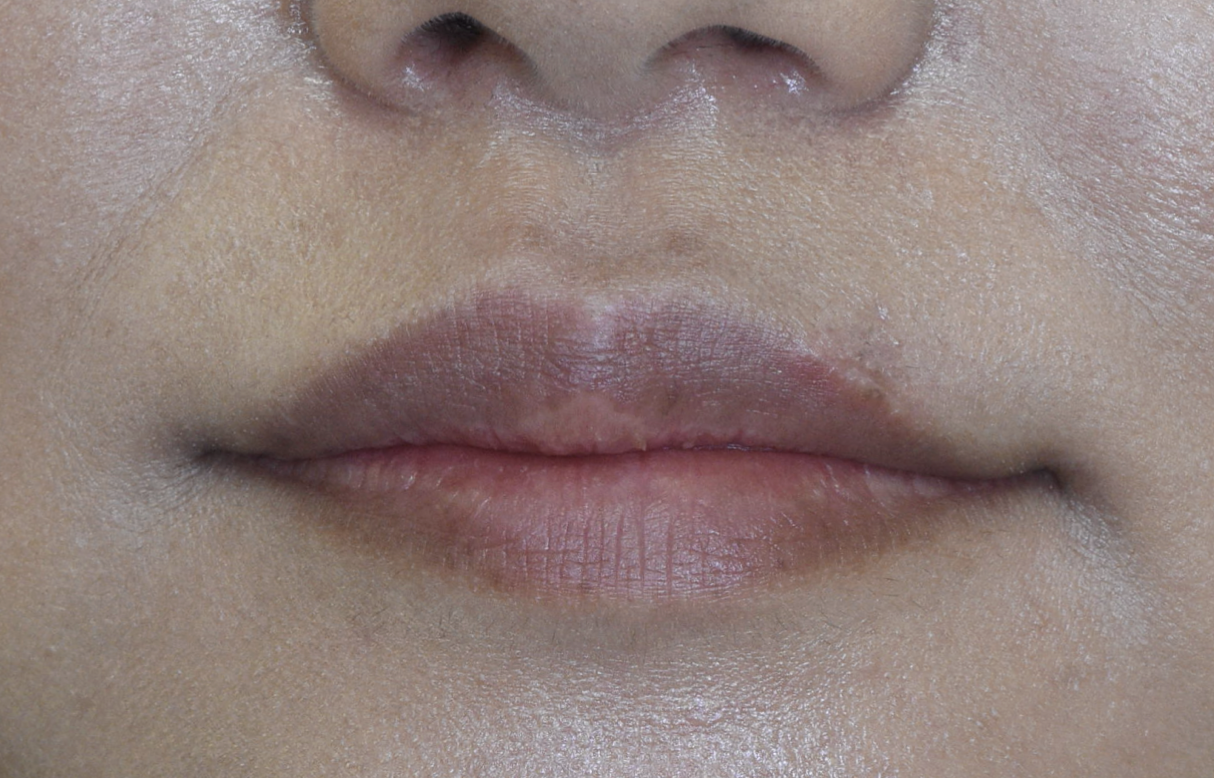 上口唇のホクロ、切除後4ヶ月の経過