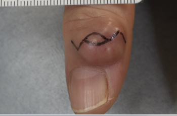 指の不整形のしこりを診たら、まず“腱鞘巨細胞腫”