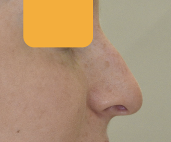 鼻形成術（ハンプ除去＋大鼻翼軟骨頭側切除＋鼻尖形成）、術後2ヶ月の経過