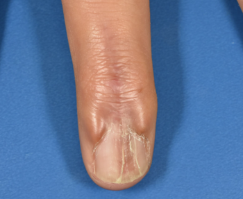爪変形の原因、外傷後の皮膚瘻孔切除後6年の経過
