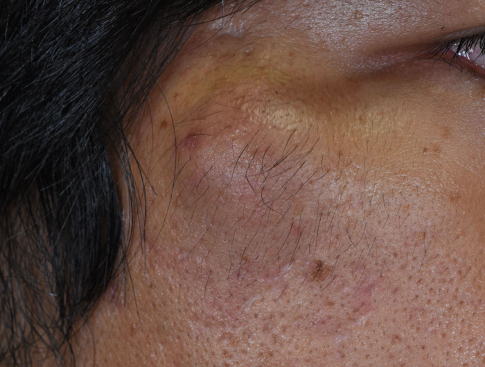 頬の大きな粉瘤、くり抜き法で治療後４ヶ月の経過
