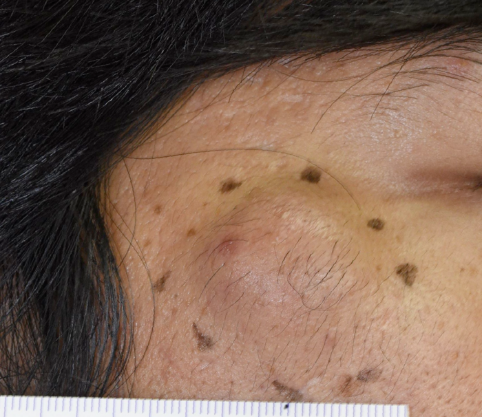 頬の大きな粉瘤、くり抜き法で治療後４ヶ月の経過
