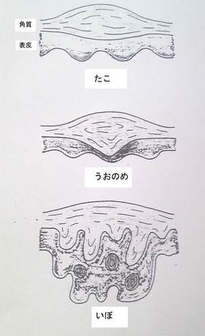 タコとイボについて