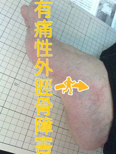 有痛性外脛骨は大人になってからも痛い(・・;) 有痛性外脛骨は大人になってからも痛い(・・;)