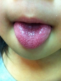 舌 いちご