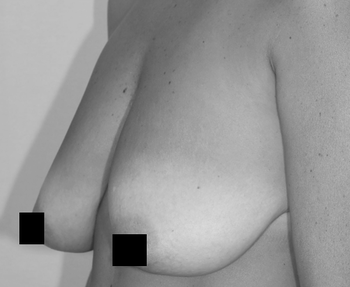 乳房リフトは、重力に逆らう手術