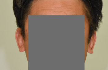 立ち耳 の手術は 要望に応じて方法を選択 Dr Kenの ゼロより１ 日記