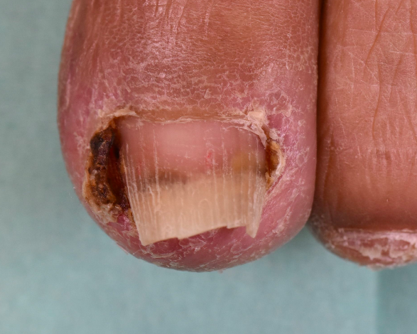 抗がん剤の副作用による皮膚と爪の障害