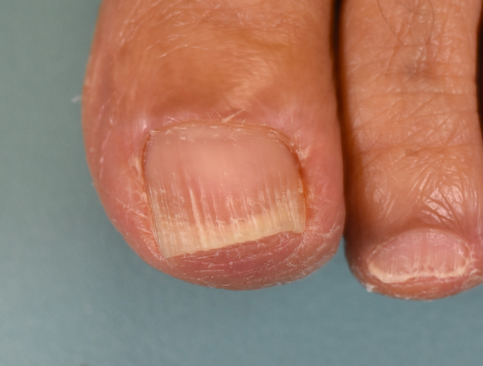 抗がん剤の副作用による皮膚と爪の障害