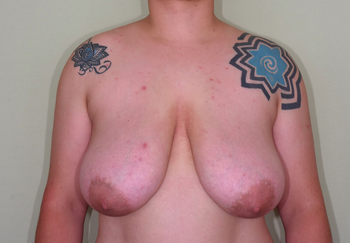 性同一性障害に対する乳房切断＋乳輪乳頭移植術後4年の経過
