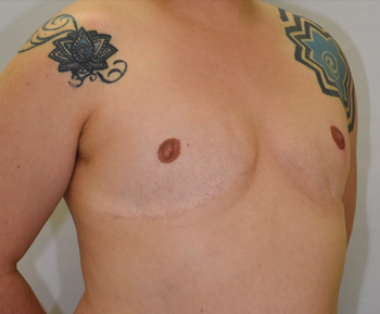 性同一性障害に対する乳房切断＋乳輪乳頭移植術後4年の経過