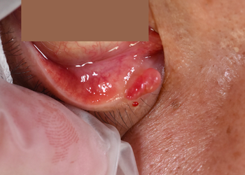 まぶたにできる要注意のできものは 脂腺がん Dr Kenの ゼロより１ 日記