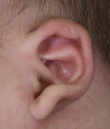 新生児の折れ耳 綿球で矯正治療後1ヶ月の経過 Dr Kenの ゼロより１ 日記