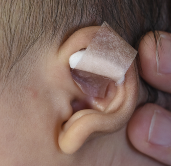 新生児の折れ耳 綿球で矯正治療後1ヶ月の経過 Dr Kenの ゼロより１ 日記