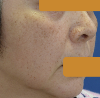 顔面のシミ、定期的に光治療中、5年間の経過