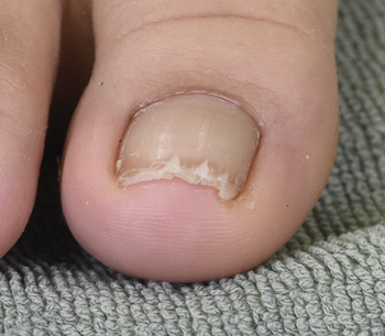 深爪による爪甲変形、アクリル樹脂で矯正後2年の経過