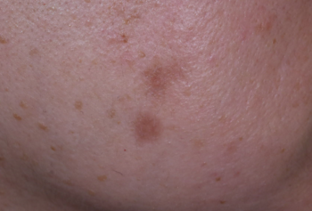 頬の脂漏性角化症、炭酸ガスレーザー治療後の色素沈着