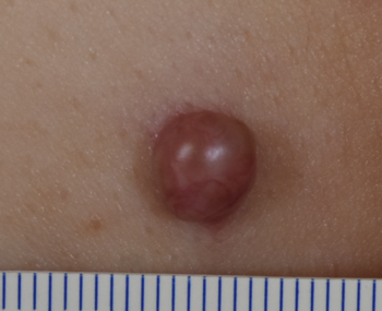胸部の赤いできもの、経過から化膿性肉芽腫