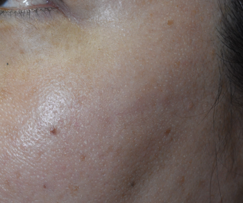 頬の脂漏性角化症、炭酸ガスレーザー治療後8年の経過