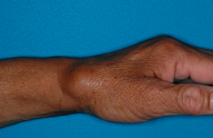 の しこり 手首 ガングリオン(手首のしこり)の原因と痛い場合の治療・対処方法