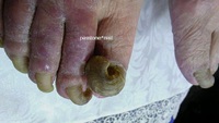 足の爪のトラブル・爪甲鉤湾症（オニコグリフォーシス）80代のお客様