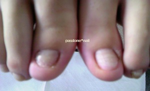 足の爪コンプレックス～爪の陥没・割れた部分・短い爪・壊れそうな爪