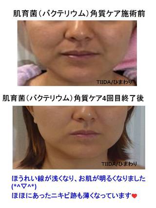 ニキビ跡・シミが薄くなった！！